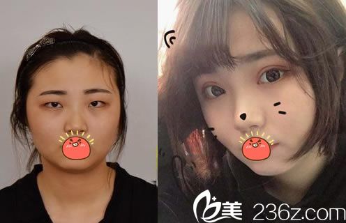 嘉兴禾美整形双眼皮案例 嘉兴禾美整形双眼皮案例
