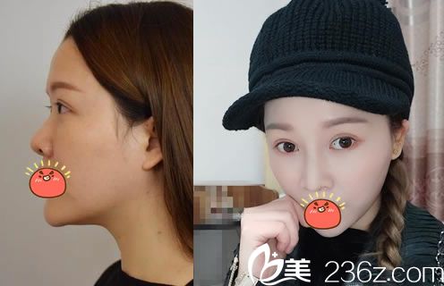 嘉兴禾美整形医院鼻综合案例 嘉兴禾美整形医院鼻综合案例