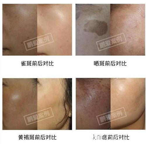 南昌鹏爱整形医院激光祛雀斑，3次/1疗程，做无斑女人，在线预约价2800