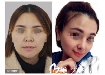 美贝尔“耳软骨隆鼻精细缝合器”案例展示