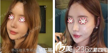 李柱洪鼻综合一个月左右