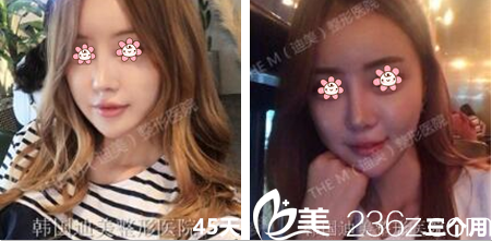 韩国迪美(THE M)整形鼻综合三个月