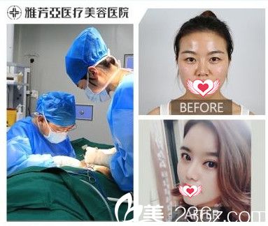 刘莎莎医生做自体软骨隆鼻案例