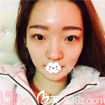 武汉涵美硅胶假体隆鼻综合整形真人案例 武汉涵美硅胶假体隆鼻综合整形真人案例