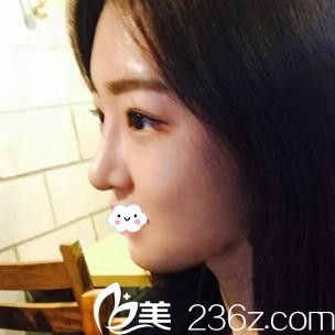 武汉涵美隆鼻整形怎么样?袁羽鼻综合案例 武汉涵美隆鼻整形怎么样?袁羽鼻综合案例