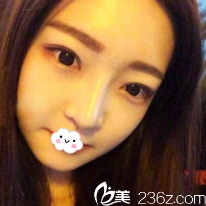 武汉隆鼻整形哪家医院好?武汉涵美鼻综合案例 武汉隆鼻整形哪家医院好?武汉涵美鼻综合案例