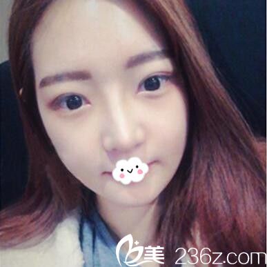 武汉涵美假体隆鼻术后恢复效果图 武汉涵美假体隆鼻术后恢复效果图