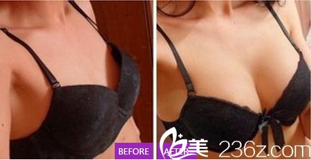 京美整形医院隆胸案例 京美整形医院隆胸案例