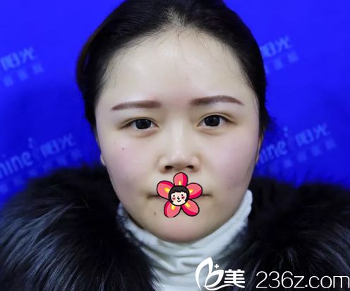 在义乌阳光医院做隆鼻手术前 在义乌阳光医院做隆鼻手术前