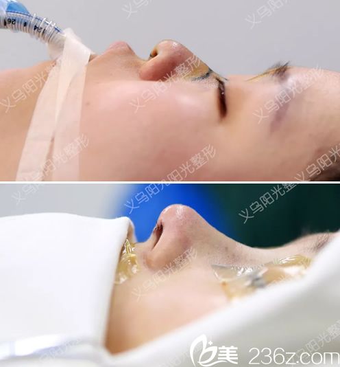 义乌阳光整形医院隆鼻<span style= 义乌阳光整形医院隆鼻<span style=