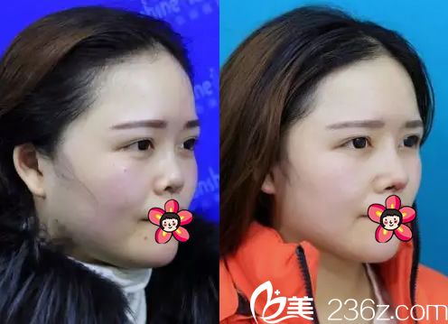 义乌阳光整形隆鼻<span style= 义乌阳光整形隆鼻<span style=