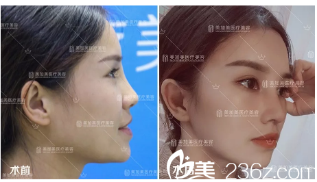 深圳美加美隆鼻案例前后对比图
