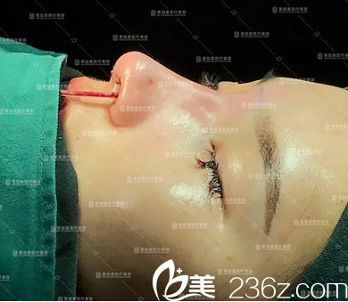深圳么佳美肋软骨隆鼻修复术后即刻效果图