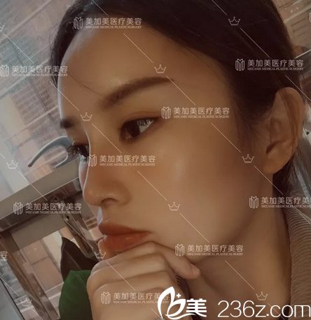 深圳美加美隆鼻案例10天自拍