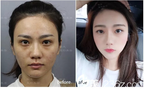 深圳美莱玻尿酸注射填充全脸案例 深圳美莱玻尿酸注射填充全脸案例