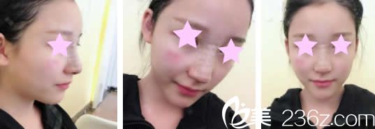 南宁美丽星李武斌给我做鼻综合术后第3天照片