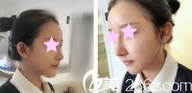 我找美丽星李武斌院长隆鼻术后第5天照片