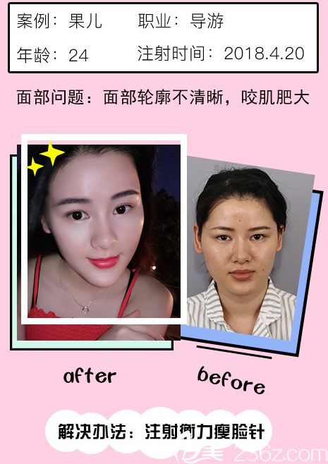 整形医院瘦脸案例 整形医院瘦脸案例