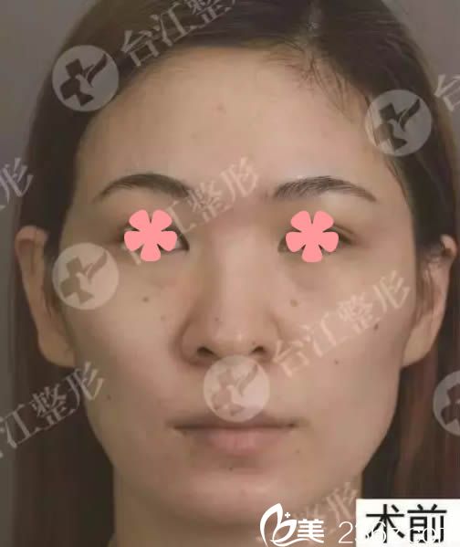 在福州台江整形医院做脂肪填充术前照 在福州台江整形医院做脂肪填充术前照