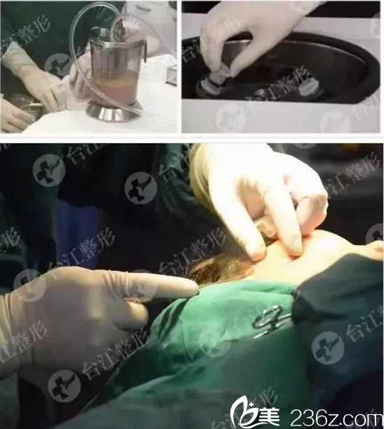 做自体脂肪填充脸手术过程图 做自体脂肪填充脸手术过程图