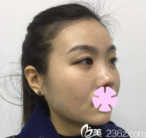 我在南宁爱思特整形做面部吸脂前的照片 我在南宁爱思特整形做面部吸脂前的照片