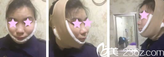 我在南宁爱思特做全脸吸脂手术当天照片 我在南宁爱思特做全脸吸脂手术当天照片