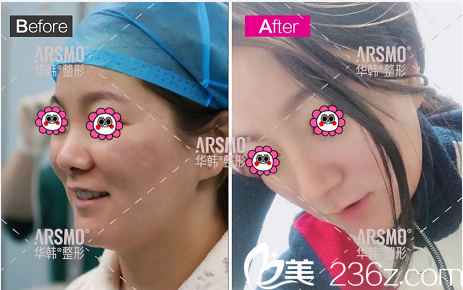 北京华韩虞守辉注射微整案例