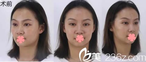 在福州名韩整形医院做隆鼻前的蒜头鼻照片 在福州名韩整形医院做隆鼻前的蒜头鼻照片