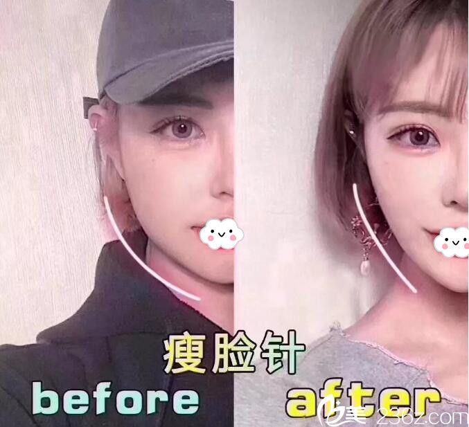 荆门和丽医疗美容注射瘦脸案例效果对比图 荆门和丽医疗美容注射瘦脸案例效果对比图