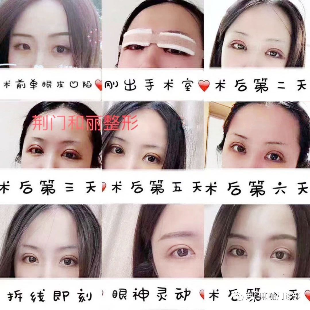 荆门和丽双眼皮术后恢复过程图 荆门和丽双眼皮术后恢复过程图