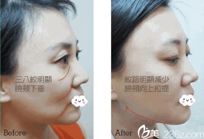 荆门和丽面部线雕埋线提升真人案例 荆门和丽面部线雕埋线提升真人案例