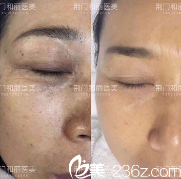 荆门和丽医疗美容激光祛斑真人案例 荆门和丽医疗美容激光祛斑真人案例