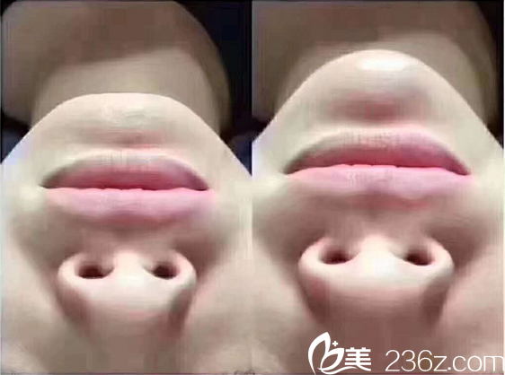 荆门和丽医疗美容玻尿酸丰下巴案例 荆门和丽医疗美容玻尿酸丰下巴案例