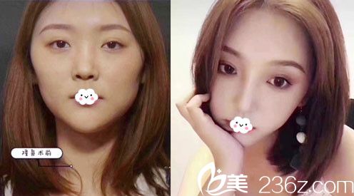 荆门和丽鼻综合隆鼻案例效果对比图 荆门和丽鼻综合隆鼻案例效果对比图