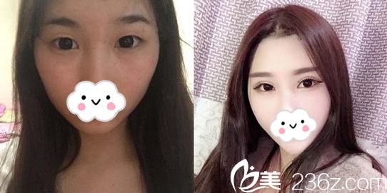 陈邦塘主任做双眼皮手术效果案例