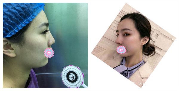 上海丽质卢九宁假体隆鼻术后10天真实案例对比