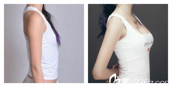 上海丽质齐金杰曼托水滴形假体隆胸术后对比照