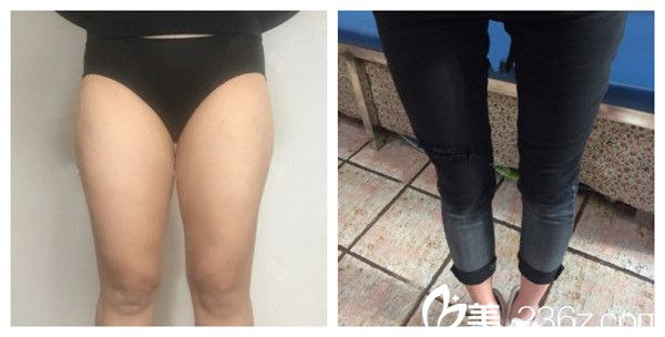 上海丽质卢九宁医生腿部吸脂塑形术后效果对比照