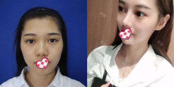 东莞韩美李阳肋软骨隆鼻对比案例 东莞韩美李阳肋软骨隆鼻对比案例