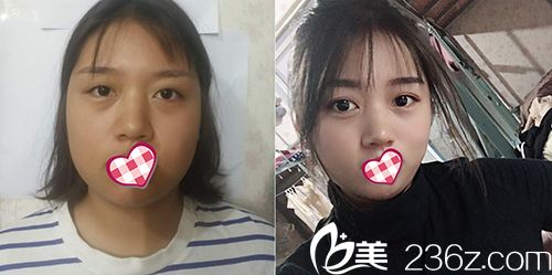 东莞韩美曾庆明切开双眼皮效果对比 东莞韩美曾庆明切开双眼皮效果对比