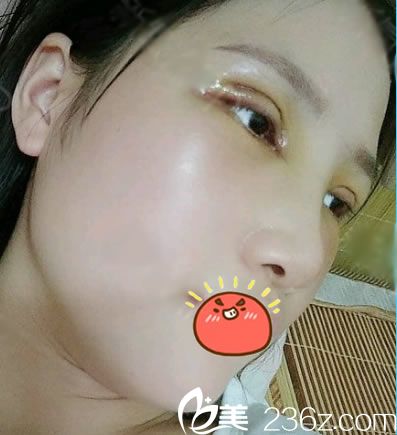 嘉兴禾美做隆鼻和双眼皮4天后