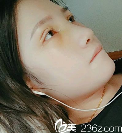做完隆鼻和双眼皮8天恢复照