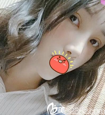 嘉兴禾美赵学燕隆鼻和双眼皮案例