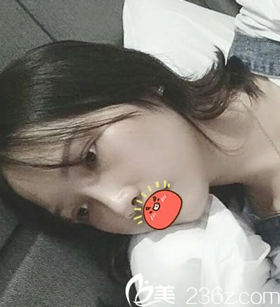 做完耳软骨隆鼻和双眼皮2月后