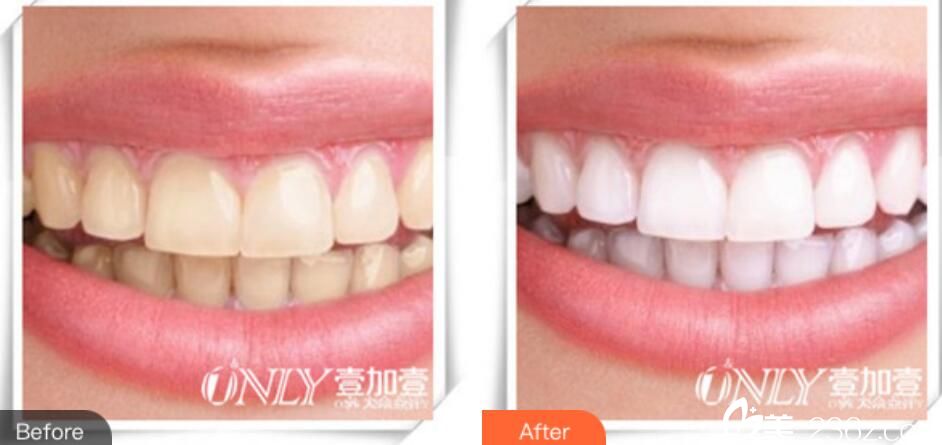 肥壹加壹程红梅好不好?看牙案例来验证 肥壹加壹程红梅好不好?看牙案例来验证