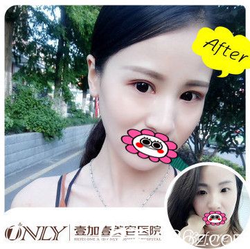 合肥壹加壹甘泉涌双眼皮前后效果图 合肥壹加壹甘泉涌双眼皮前后效果图