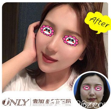合肥壹加壹瘦脸案例图 合肥壹加壹瘦脸案例图