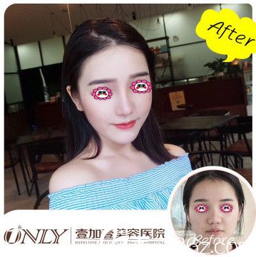 合肥壹加壹孟松隆鼻变化图 合肥壹加壹孟松隆鼻变化图