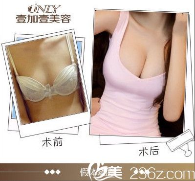 壹加壹隆胸前后对比图 壹加壹隆胸前后对比图