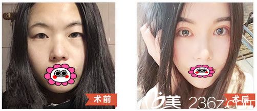 包头华美医疗美容白虎双眼皮前后对比图 包头华美医疗美容白虎双眼皮前后对比图
